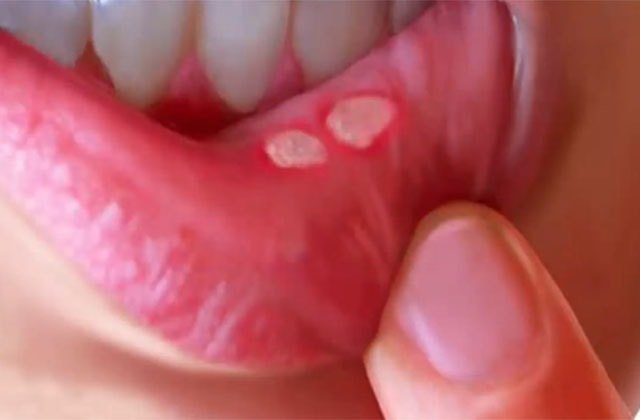 Homeopathic Medicines For Mouth Ulcers