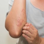 homeopathic remedies for skin rashes