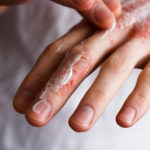 homeopathic remedies for cracked skin