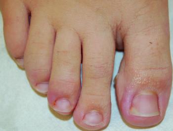 homeopathic treatment of ingrown toenail
