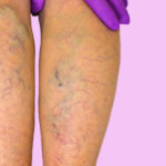 venous insufficiency homeopathy