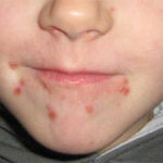 homeopathic treatment for hand, foot and mouth disease